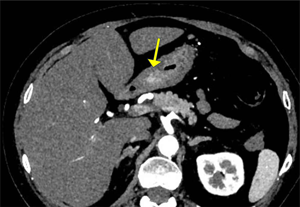 図1．早期動脈相