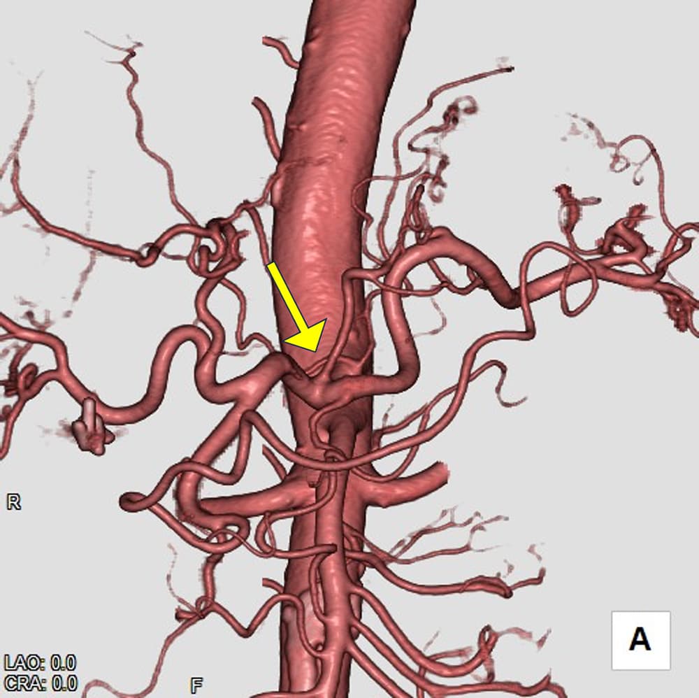 図3．3D画像(動脈)