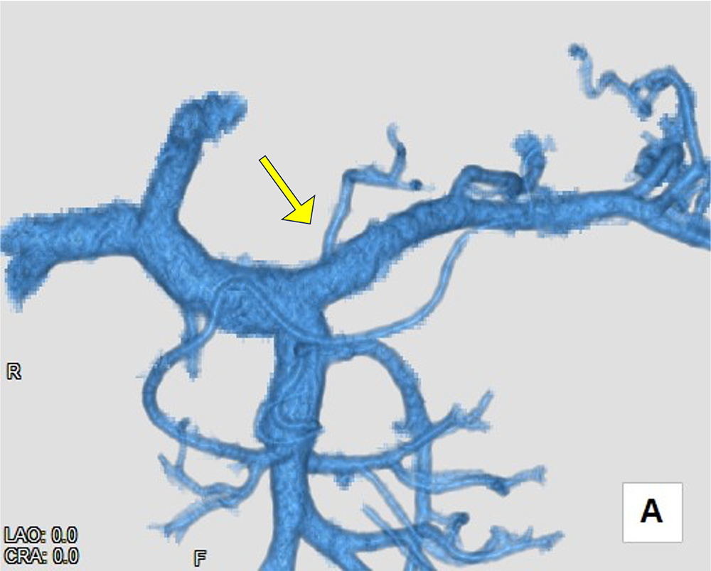 図4．3D画像(門脈)