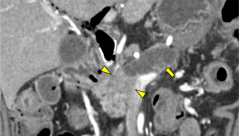 図1．造影CT 膵実質相 Coronal像 70keV