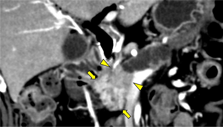 図2．造影CT 膵実質相 Coronal像 40keV