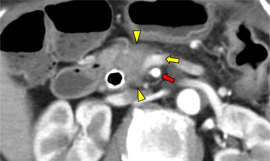 図3．造影CT 膵実質相 Axial像 70keV