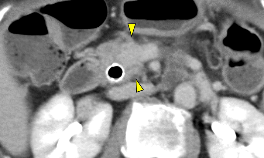 図4．造影CT 平衡相 Axial像 70keV