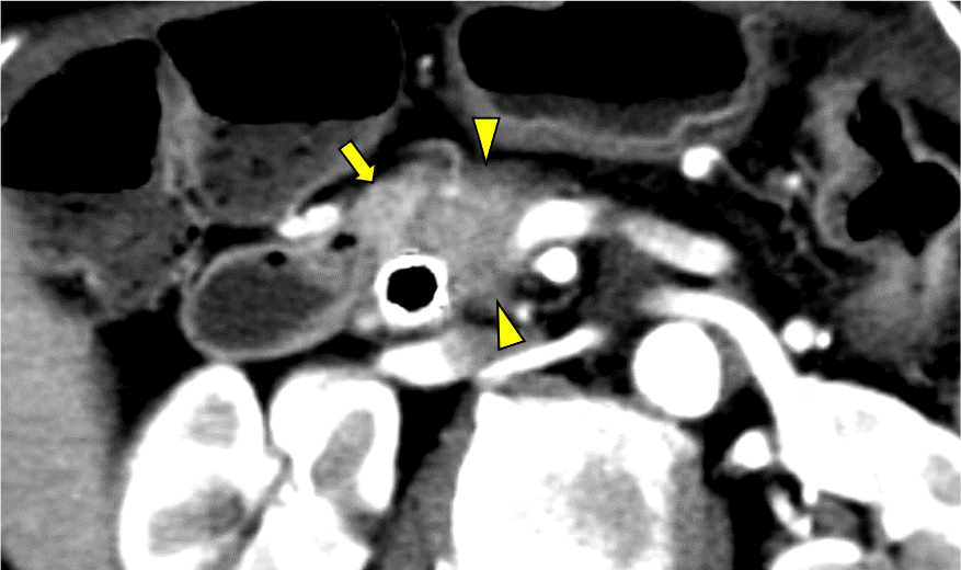 図5．造影CT 膵実質相 Axial像 40keV