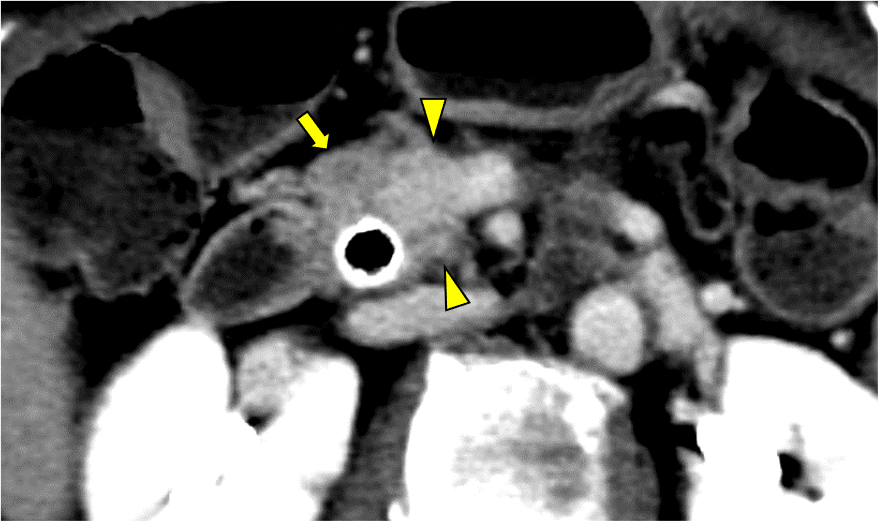図6．造影CT 平衡相 Axial像 40keV