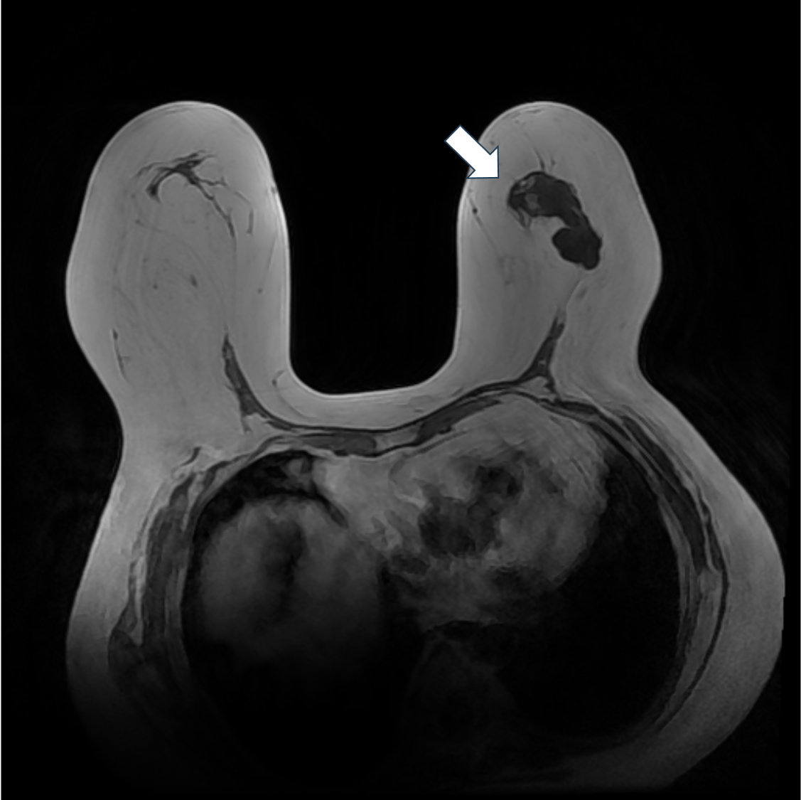 1. T1強調画像（造影前）