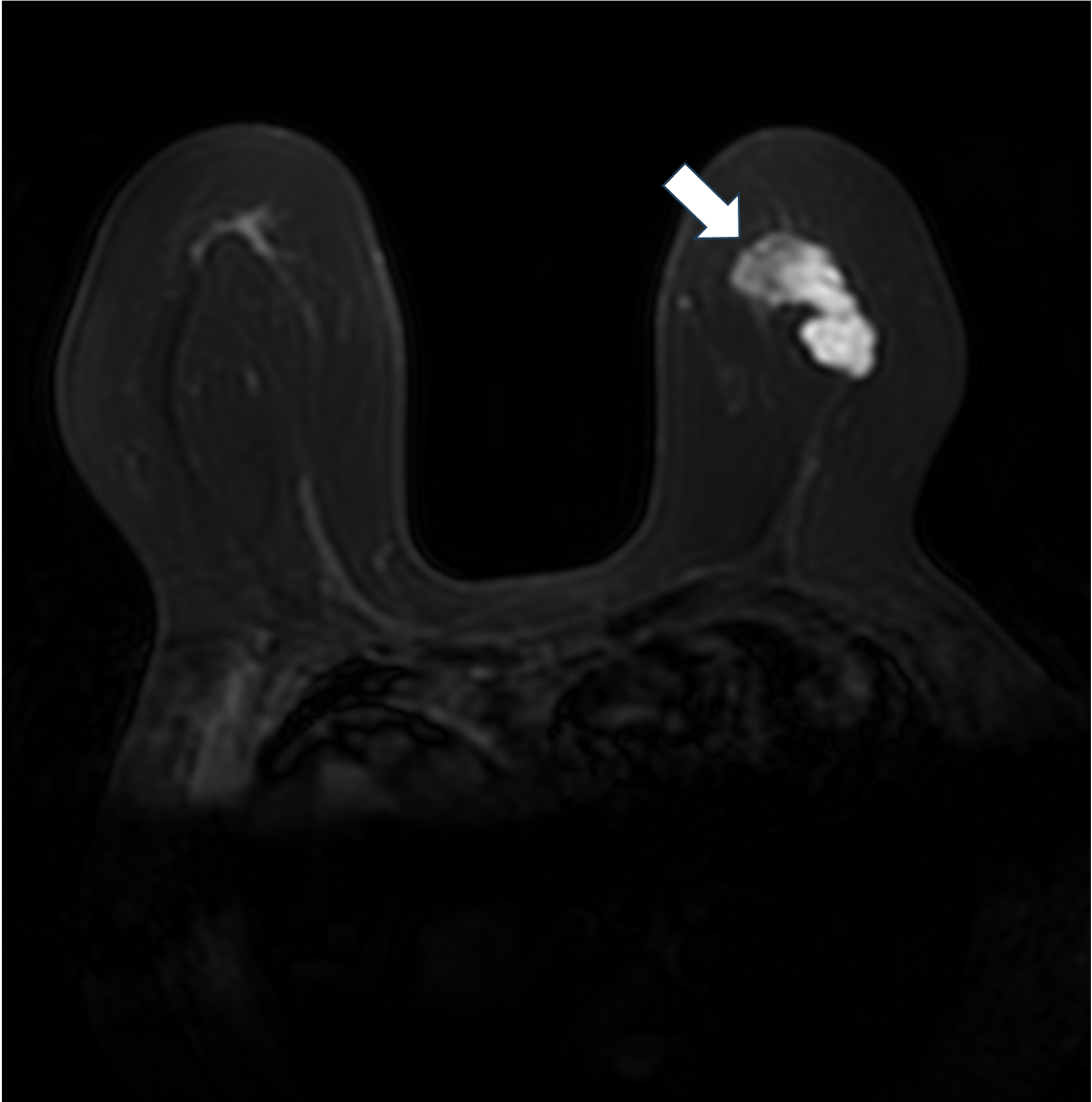 2. 脂肪抑制T2強調画像（造影前）