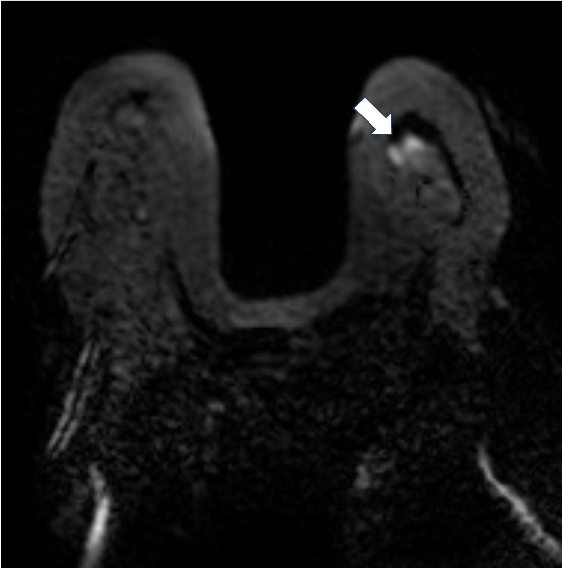 3. 拡散強調画像　b=1000(s/mm2)（造影前）