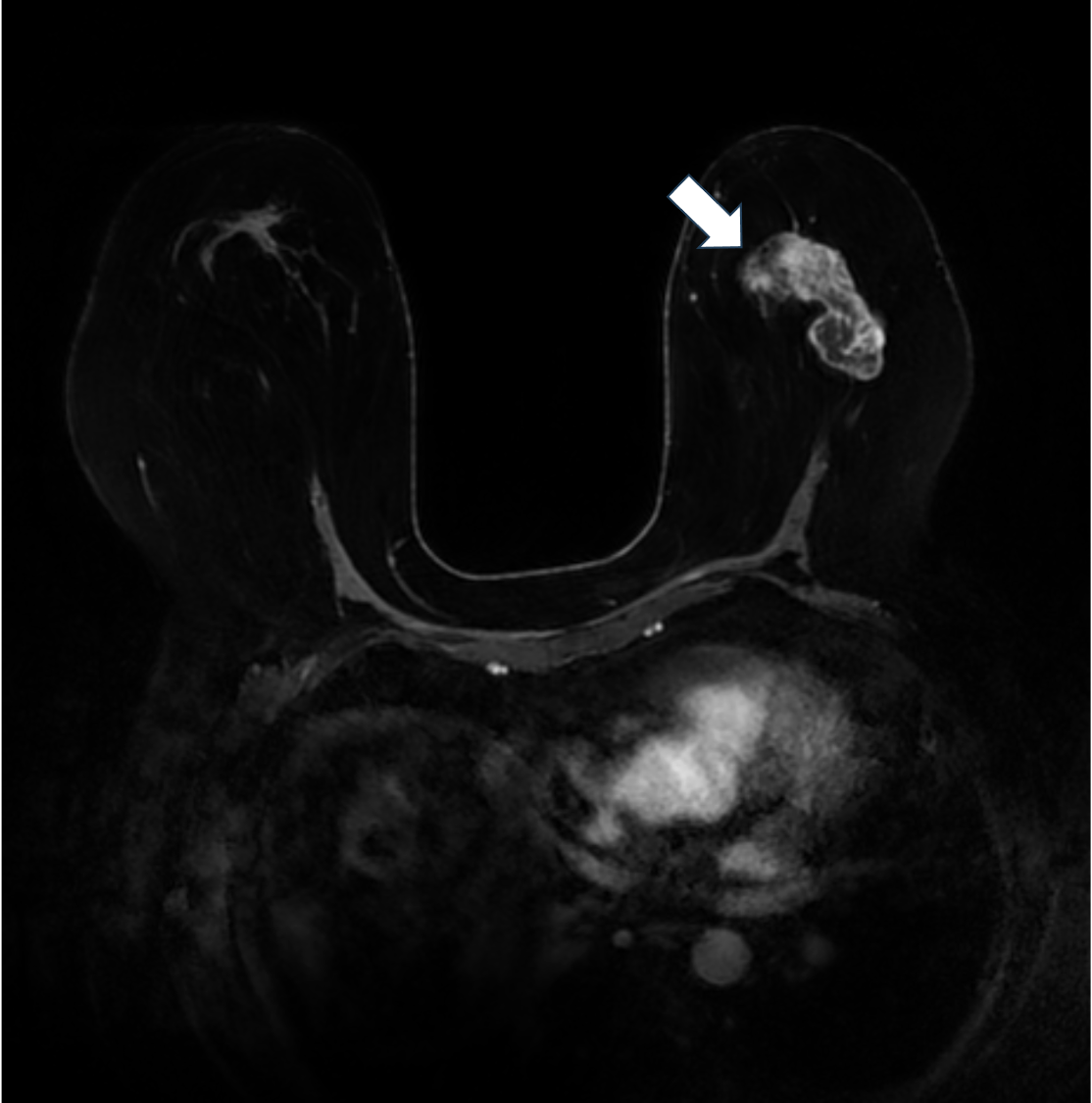 5. ダイナミックMRI 早期相