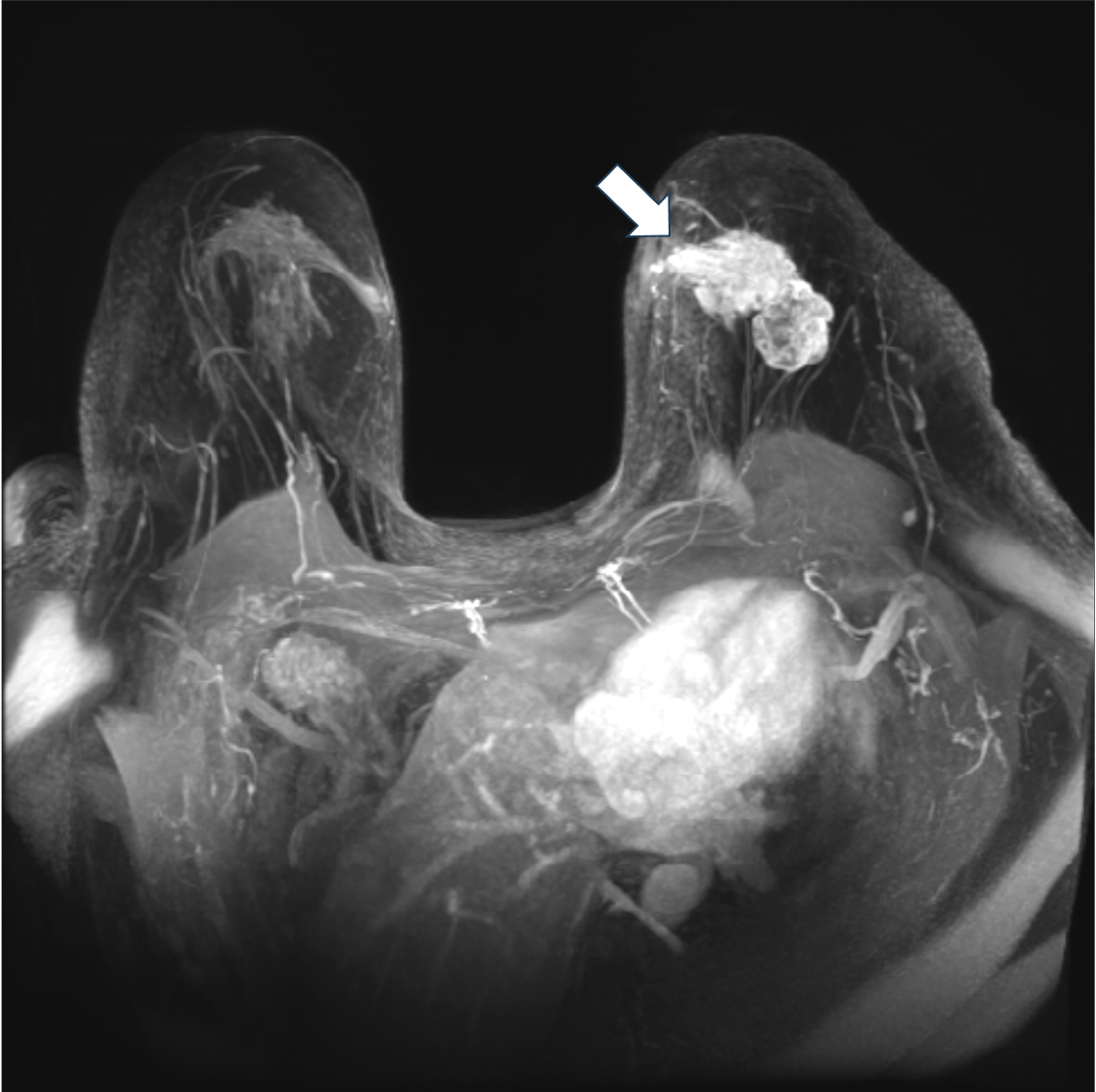 6. ダイナミックMRI 早期相　MIP像