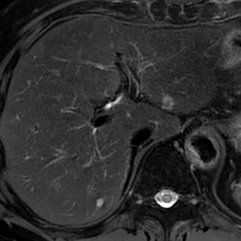 図1．単純脂肪抑制T2WI