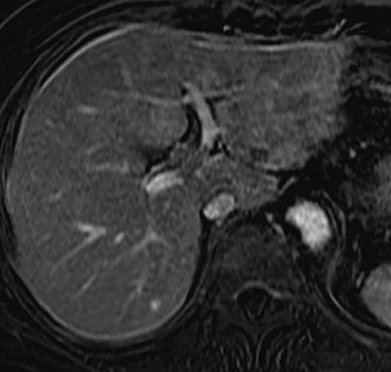 図3．造影T1WI後期相