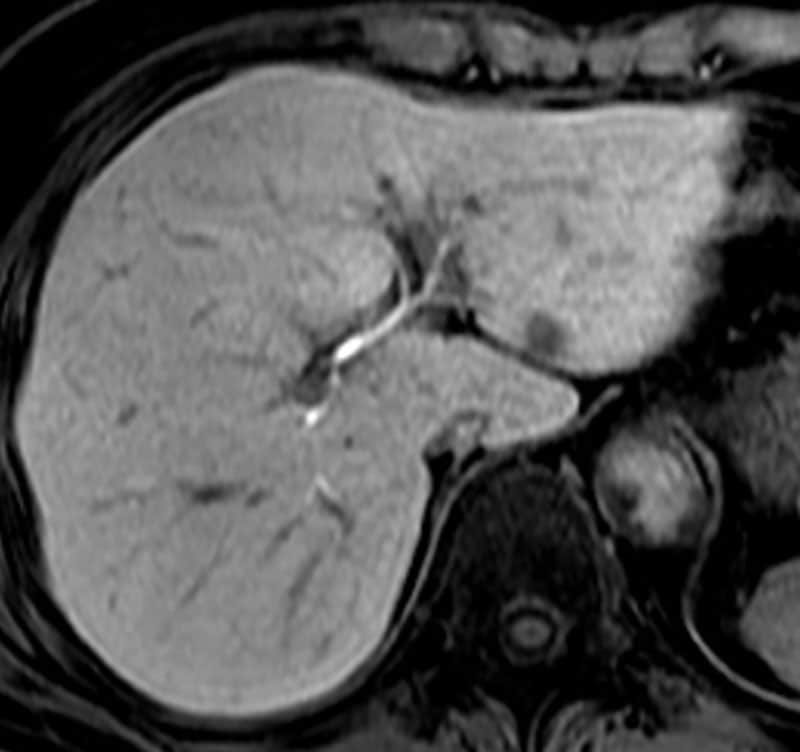図4．造影T1WI肝細胞相