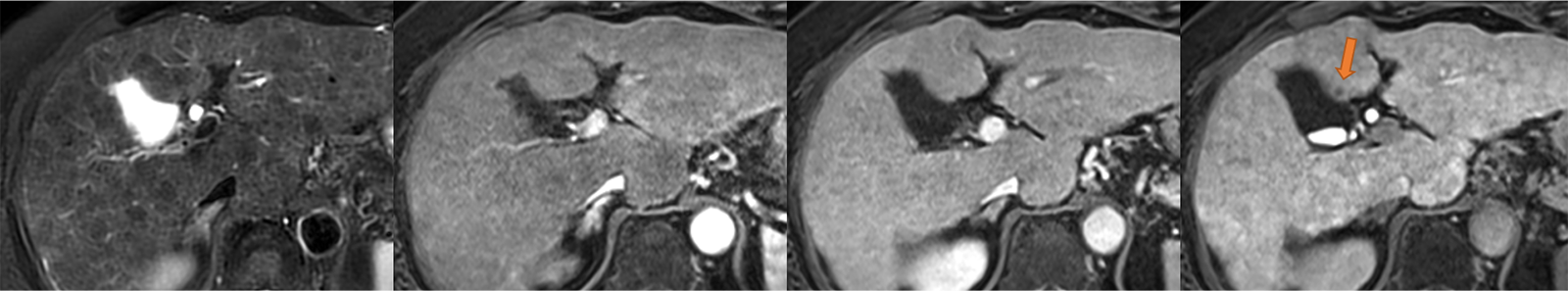 図1．初診時EOB-MRI画像（左から脂肪抑制T2強調画像、動脈相、門脈相、肝細胞相）