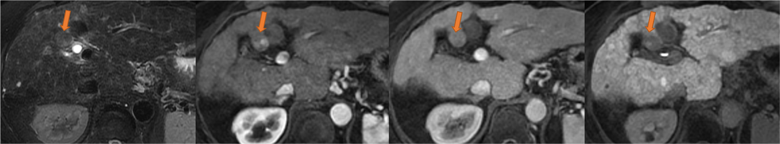 図3．46ヶ月後のEOB-MRI画像（左から脂肪抑制T2強調画像、動脈相、門脈相、肝細胞相）