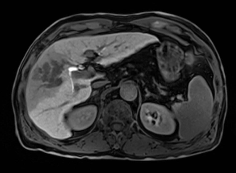 図4．治療前肝細胞相