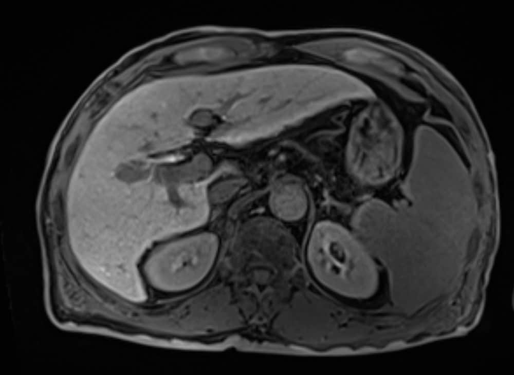 図5．4コース治療後肝細胞相