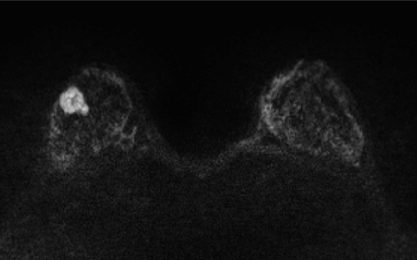 1.拡散強調画像　(造影前)