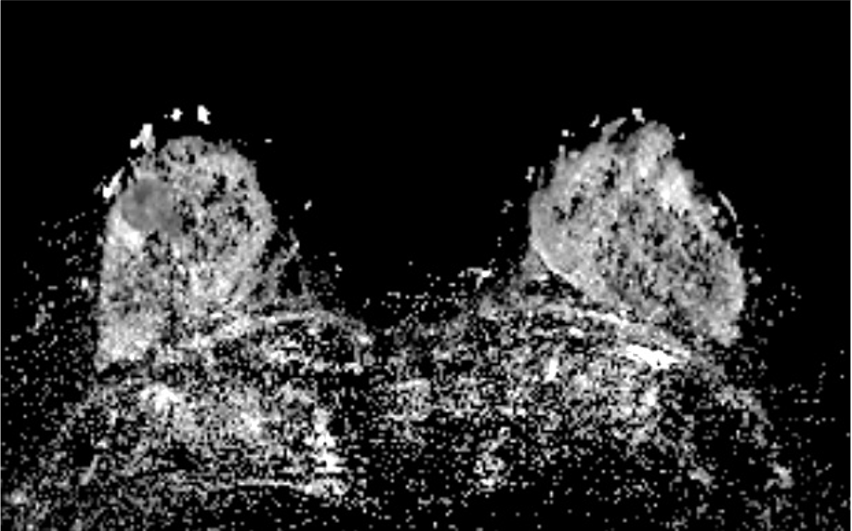 1.拡散強調画像　(造影前)