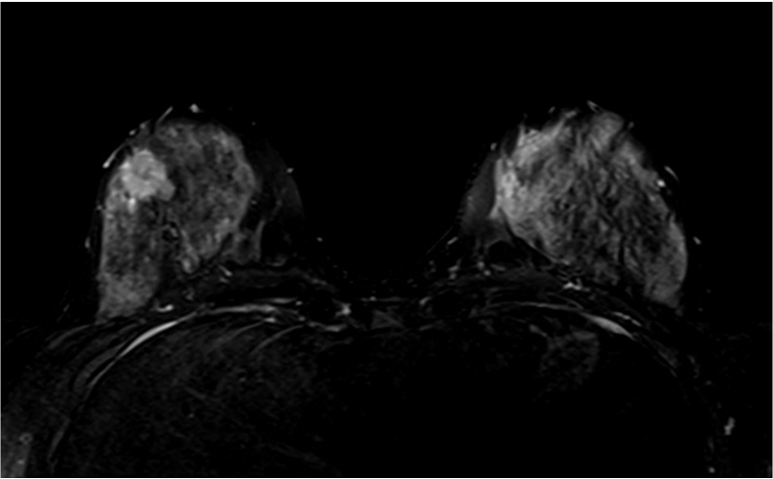 2. T2強調画像　(造影前)