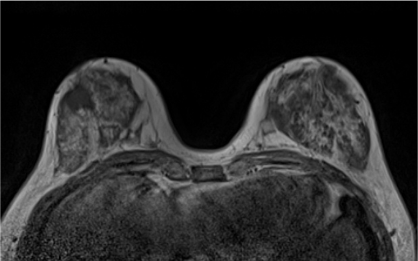 3. T1強調画像 (造影前)