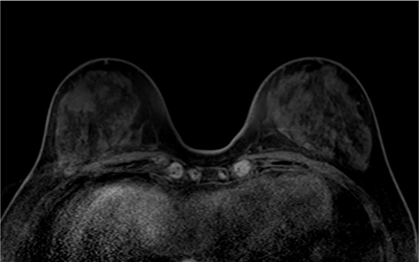 4. ダイナミックMRI (造影前 早期相 遅延相)