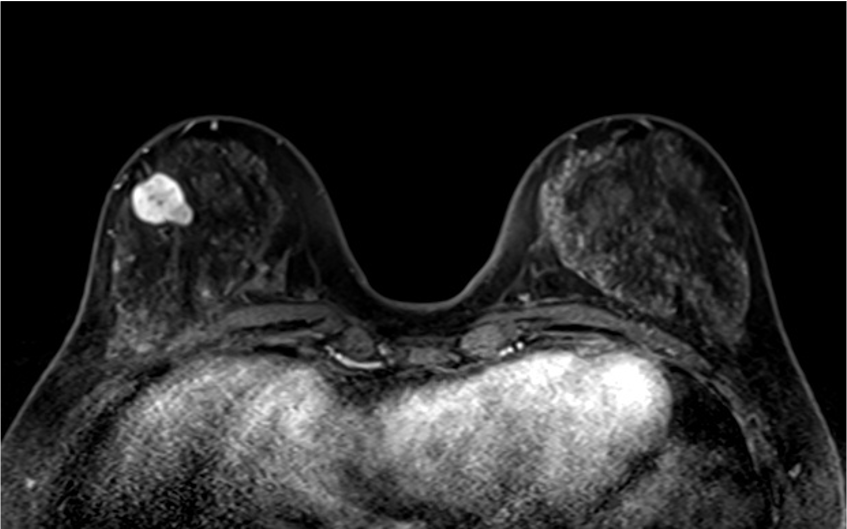 4. ダイナミックMRI (造影前 早期相 遅延相)