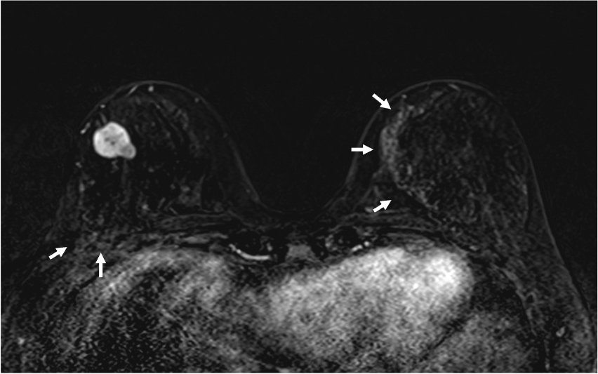 4. ダイナミックMRI (造影前 早期相 遅延相)