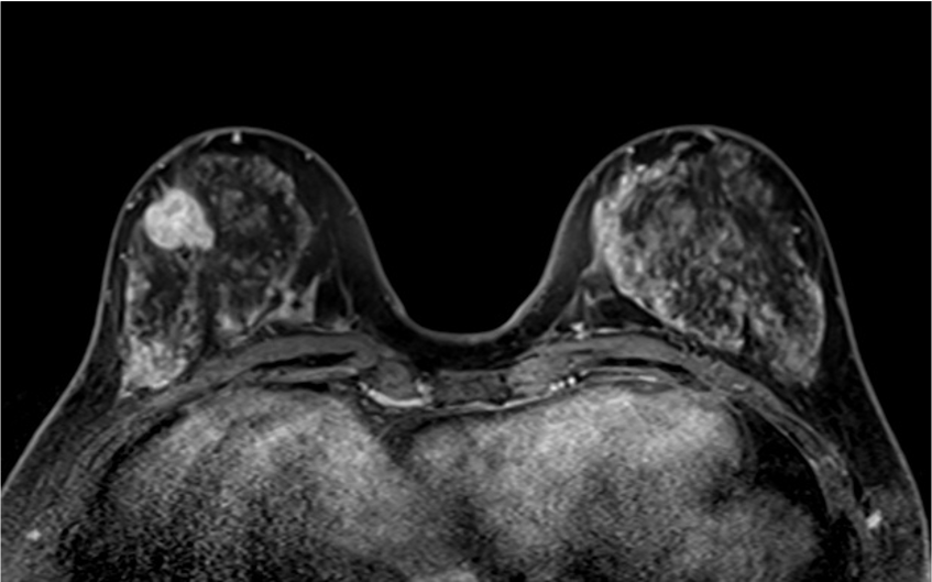 4. ダイナミックMRI (造影前 早期相 遅延相)