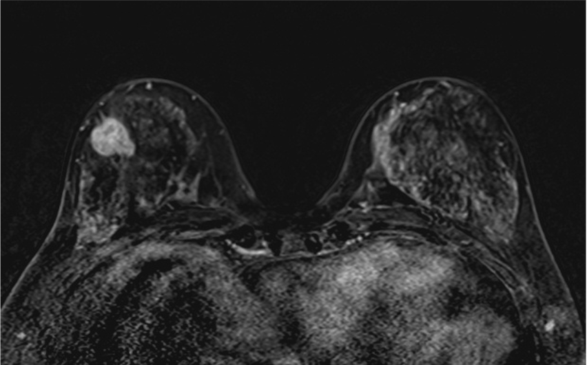 4. ダイナミックMRI (造影前 早期相 遅延相)