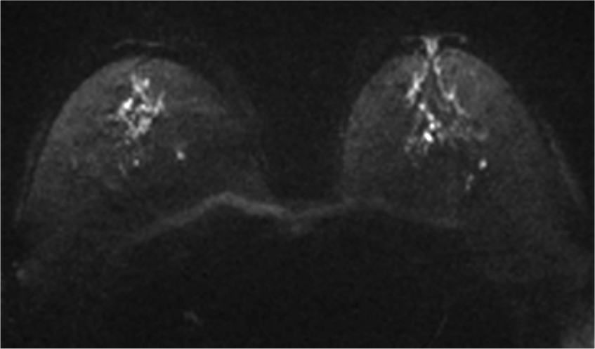 1. 拡散強調画像 b=1000 (s/mm2) (造影前)