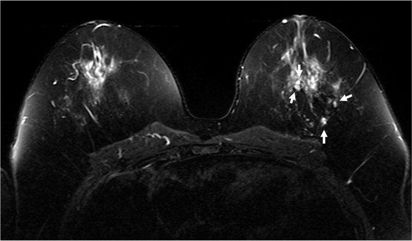 2. T2強調画像 (造影前)