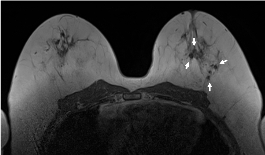 3. T1強調画像 (造影前)