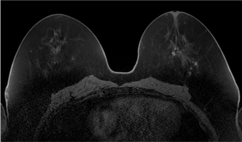  4. ダイナミックMRI (造影前 早期相 遅延相)