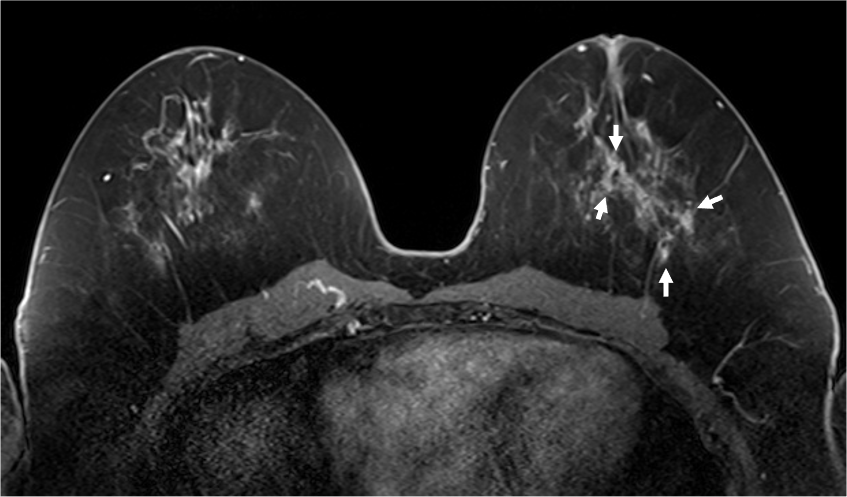  4. ダイナミックMRI (造影前 早期相 遅延相)