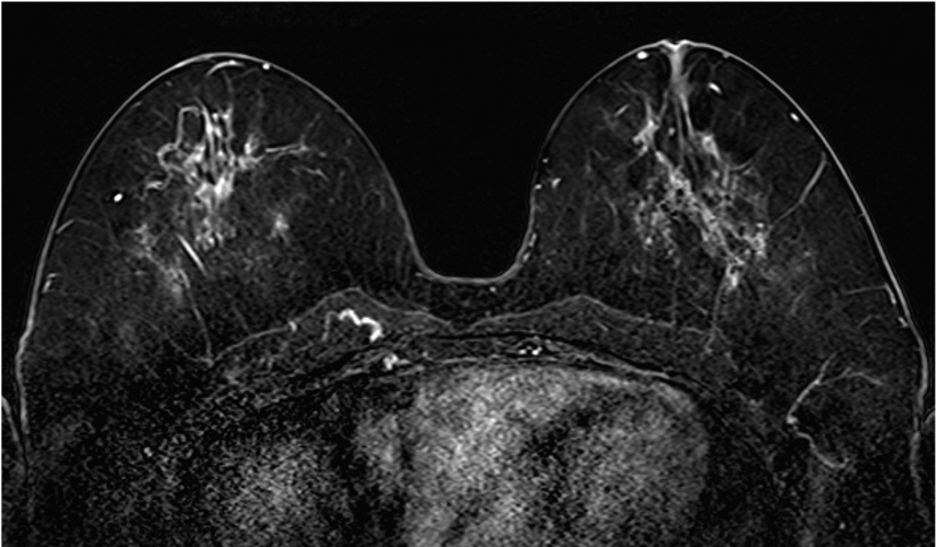  4. ダイナミックMRI (造影前 早期相 遅延相)