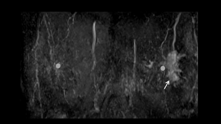 1. ダイナミックMRI　早期相MIP画像（正面）