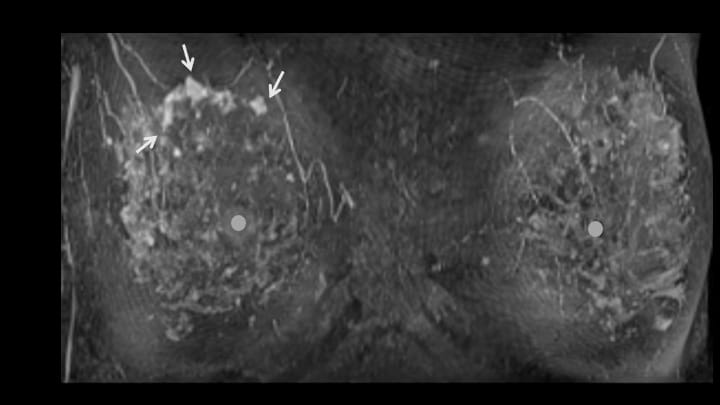 1. ダイナミックMRI　早期相MIP画像（正面）
