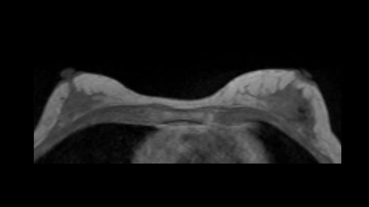 2. T1強調画像（造影前）