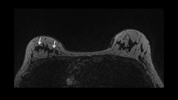 2. T1強調画像（造影前）