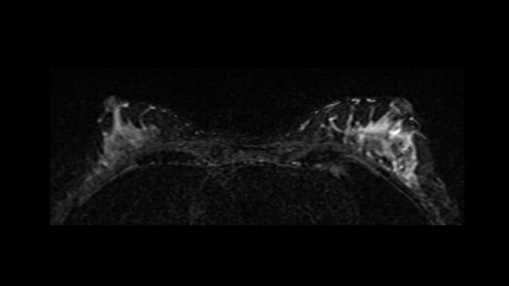 3. 脂肪抑制T2強調画像（造影前）