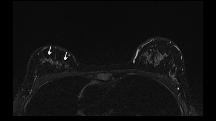 3. 脂肪抑制T2強調画像（造影前）