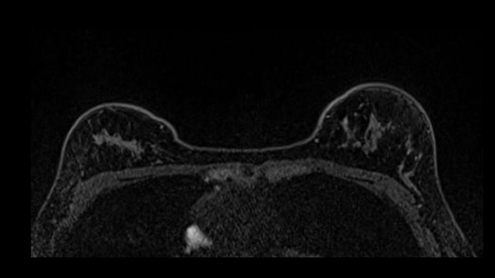 4. ダイナミックMRI（造影前）