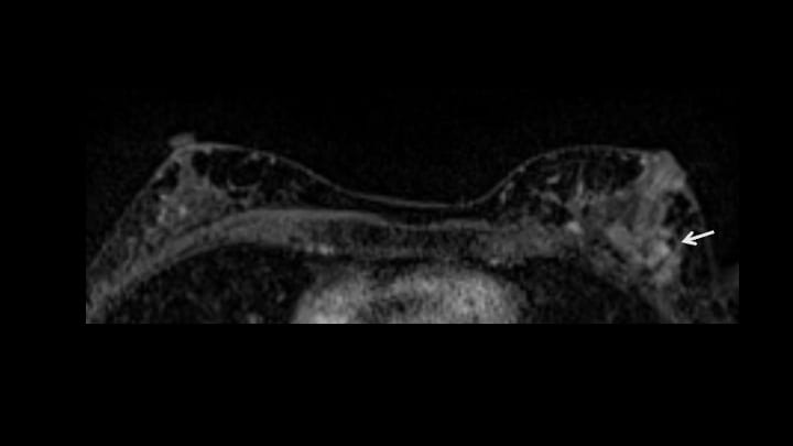 5. ダイナミックMRI 早期相