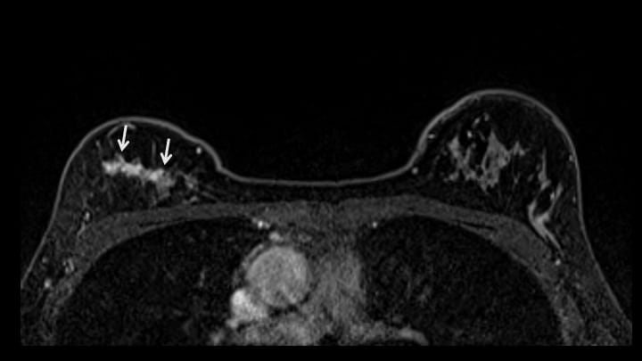 5. ダイナミックMRI 早期相