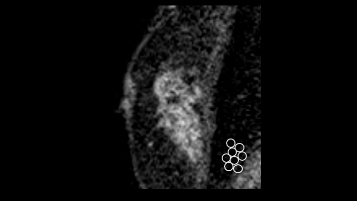 6. 造影後高分解能T1強調画像