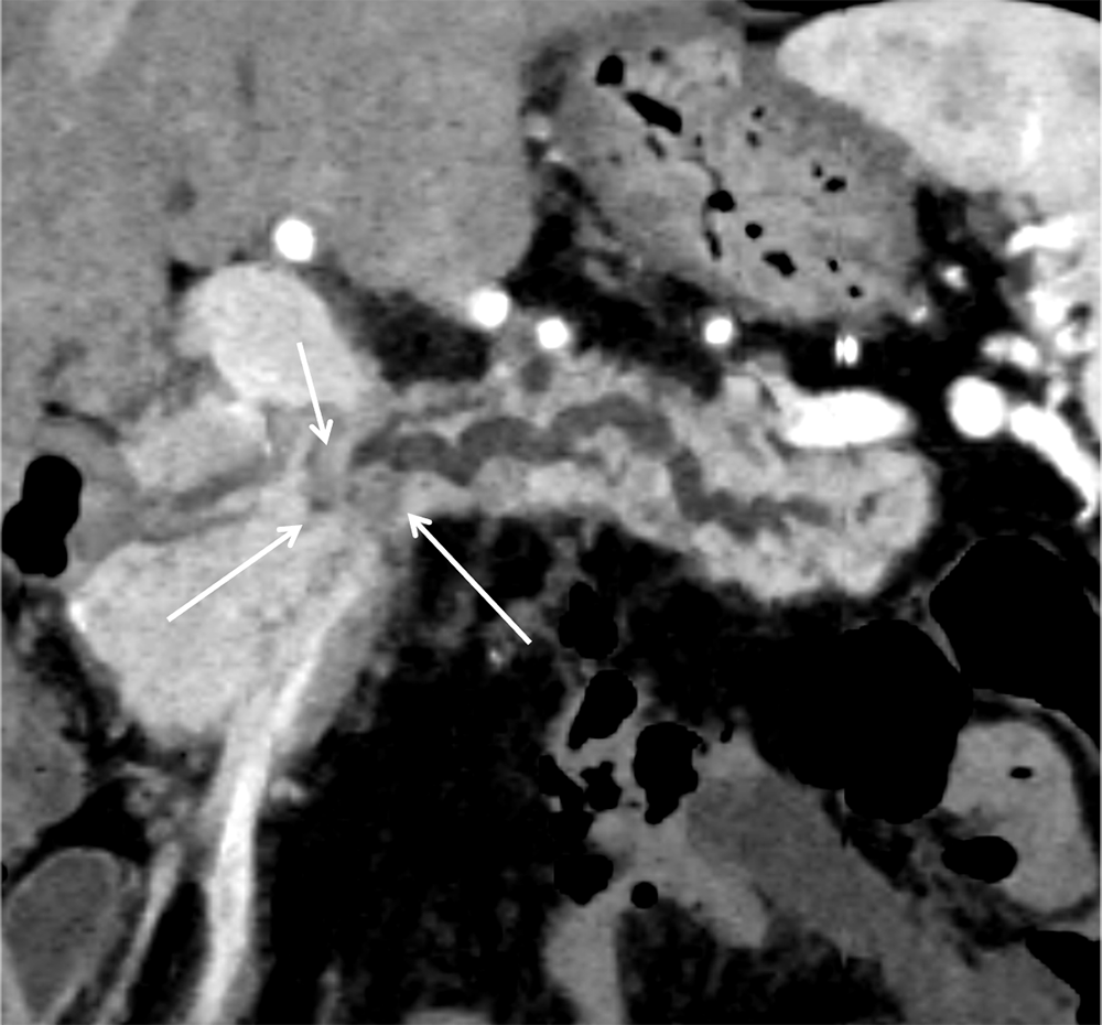 図１．膵実質相（斜冠状断像）