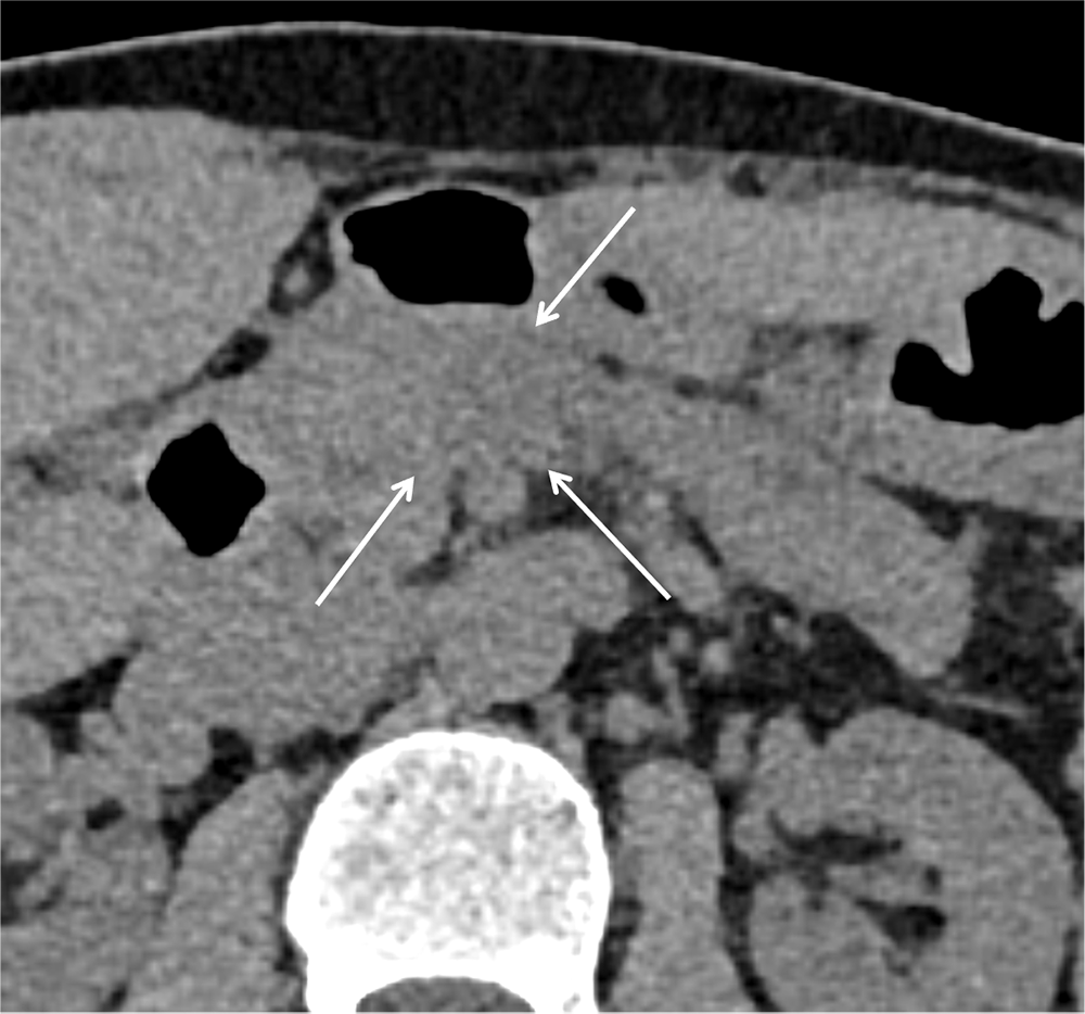 図2．単純（水平断面像）
