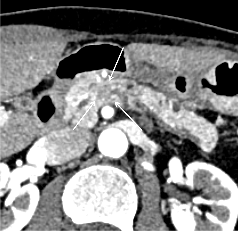 図3．膵実質相（水平断面像）