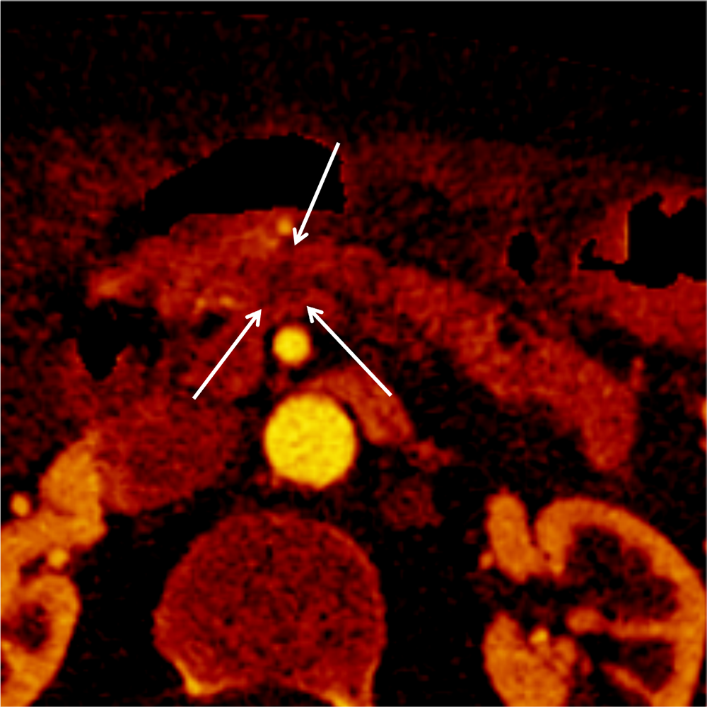 図4．Iodine map（膵実質相、水平断面像）